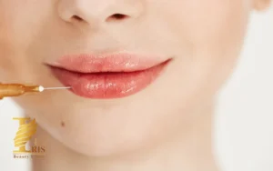 تزریق ژل لب روسی
