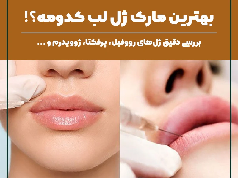 بهترین مارک ژل لب (ژوویدرم، رووفیل یا پرفکتا؟) | قیمت بهترین مارک ژل لب ...