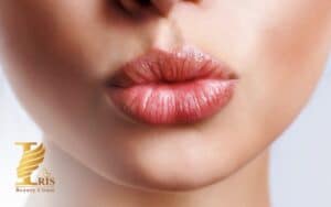 تزریق ژل لب مدل قلوهای