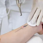 پاک کردن تاتو با لیزر