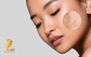 تعداد جلسات میکرونیدلینگ
