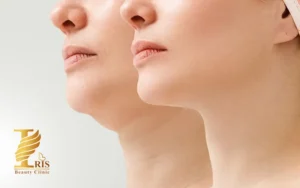 تجربه بعد از مزوتراپی غبغب