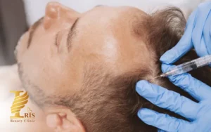 تعداد جلسات مزوتراپی مو