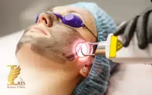 قیمت کربن تراپی صورت