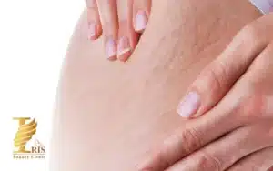 کربوکسی تراپی برای ترک پوست